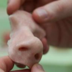 14-year-old receives first 3-D printed nose