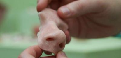14-year-old receives first 3-D printed nose