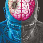 Researchers said that the findings can change the way the most common form of stroke is treated globally, including in India where an estimated 1.2 million people suffer from ischaemic strokes. (webmd)