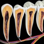 Dental root tip infection