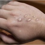 Monkeypox