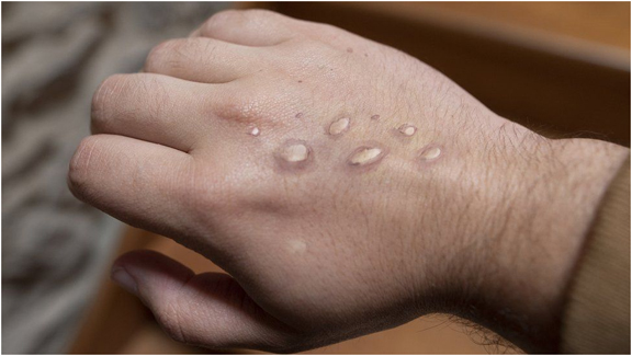 Monkeypox