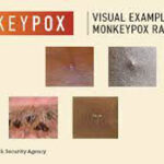 Monkeypox CDC