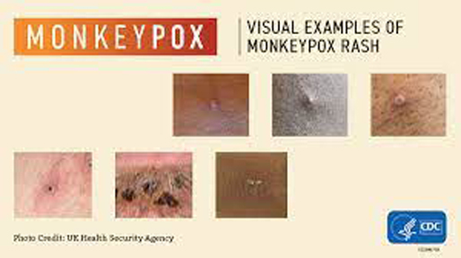 Monkeypox CDC